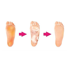 Exfoliačné ponožky na zrohovatenú kožu, 4 ks – VÝPREDAJ, EXSPIRÁCIA 19.5.2025