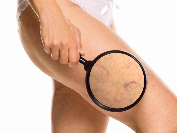 Ako na kŕčové žily? Stavte na zdravý životný štýl a kompresné pančuchy ako prevenciu